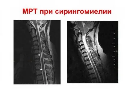 Сирингомиелия на шийката на матката и гръбнака на гръдния кош, gidromieliya, лечение, народни средства за защита,