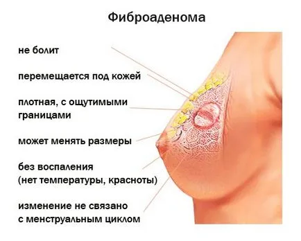 Simptomatologia, cauzele si tratamentul fibroadenom mamar