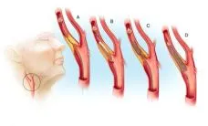 Stentarea arterelor carotide interne - comunitatea online neurochirurgi Roscii