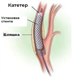 Carotis stentbeültetést - alternatívájaként carotis endarteriectomia