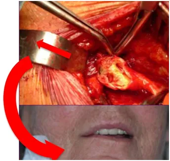 Carotida stenting - o alternativă la endarterectomia carotidei