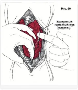 Thyreoidectomia pajzsmirigy daganatok kutyákban