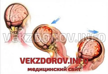 Brain clinica prejudiciu, clasificare, diagnostic, tratament, prognostic