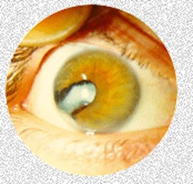 Всички травматична катаракта и неговите функции, за очното заболяване
