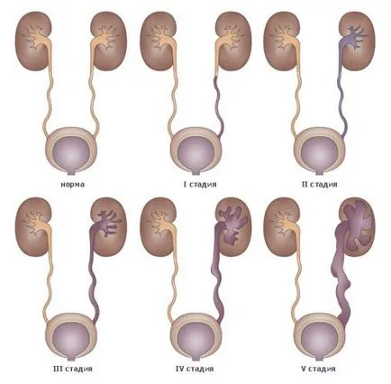 expansiune ureterului congenitale - megaureter, Tratament în Israel