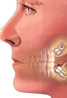 Blog-ne sfaturi de ce dintii intelepciunea