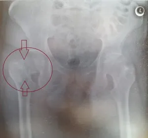 Bipoláris arthroplasty - CDB Rendelőintézet veri az orosz elnök