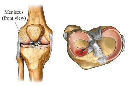 Durere în cauzele comune genunchiului si optiuni de tratament