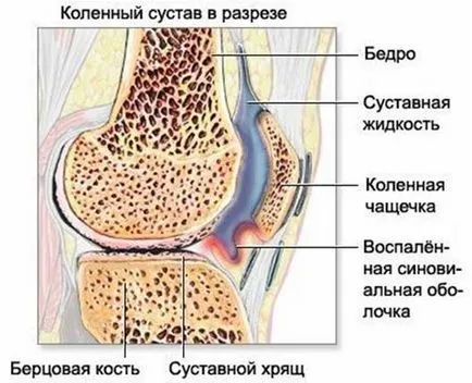 Болка в коляното или защо боли коленните стави