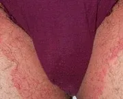 Eczema în inghinală cum să facă față cu simptome care cauzează boala și dacă aceasta poate fi vindecat