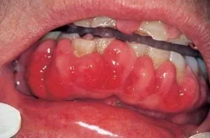 Фиброматоза венците причини, форми, симптоми, лечение