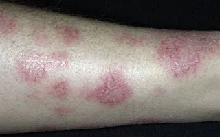Ekcémás dermatitis - okai, tünetei és kezelése (fotó)