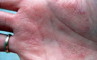 Ekcémás dermatitis - okai, tünetei és kezelése (fotó)