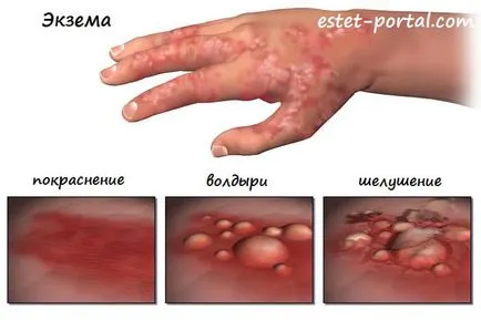 Симптоми и методи за лечение на заболяване екзематозен дерматит
