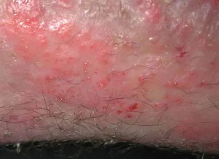 Eczema în inghinală cum să facă față cu simptome care cauzează boala și dacă aceasta poate fi vindecat