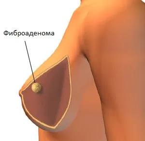 Galactocele на гърдата, който е и опасността