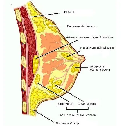 Galactocele на гърдата, който е и опасността