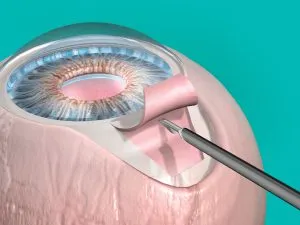 glaukóma műtét