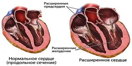 Hipertrofia inimii ceea ce este, cauze si tratament