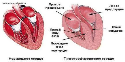 Hypertrophia a szív, mi ez okozza és a kezelés