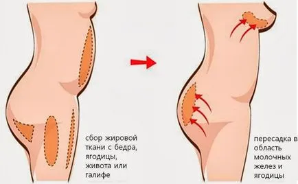 Хипоплазия на гърдата, защото от това, което се е случило неразвитостта на гърдите, проблемите за лечение