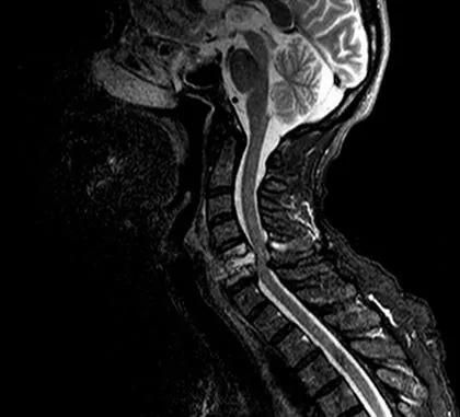 simptome ale coloanei vertebrale accident vascular cerebral din cordonul ombilical, reabilitare, sănătate a capului