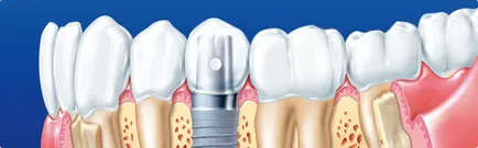 Implanturile dentare față și spate, prețul la cheie