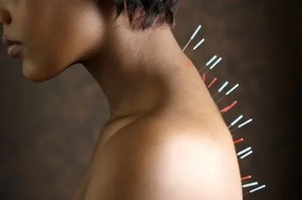 Akupunktúra (akupunktúra) a osteochondrosis a nyaki és az ágyéki gerinc