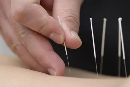 Akupunktúra, vagy akupunktúrás a rák kezelésére