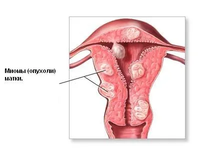 Cum să se ocupe cu miom uterin