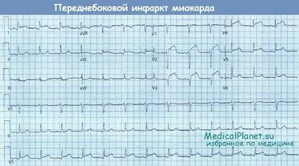 Промените в ЕКГ остър коронарен синдром (ACS)