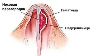 Răni în cauzele cavității nazale și tratamentul