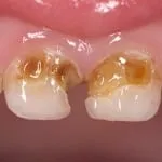 Caries elülső fogak csinálni fotók kezelés előtt és után