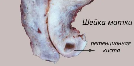 маточната шийка киста - какво е това (снимка)