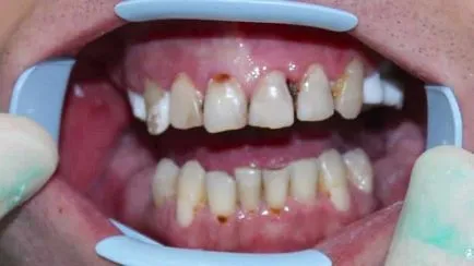 Caries elülső fogak csinálni fotók kezelés előtt és után