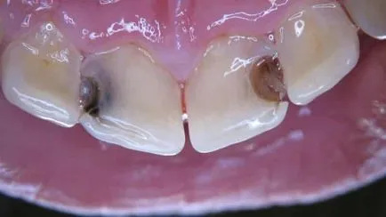 Caries elülső fogak csinálni fotók kezelés előtt és után