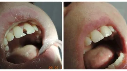 Caries elülső fogak csinálni fotók kezelés előtt és után