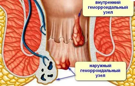 Рициново масло лечение на хемороиди и противопоказания