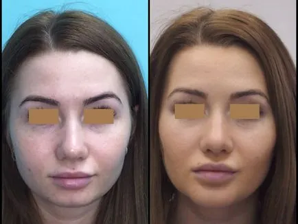 Alaki plasztika arccsont különféle plasztikai műtét a arccsont, a stádiumában