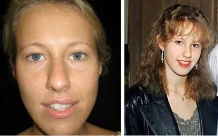 Ksenia Sobchak fotó előtt és után orrplasztika, mandibuloplastiki és egyéb plasztikai sebészet