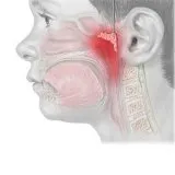 adenoids terapie rece - bisturiu - informații medicale și portal educațional