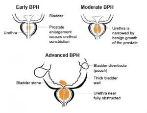 tratamentul HBP