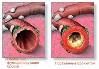 Кашлица лечение народни средства колко бързо лекува кашлица народната медицина у нас