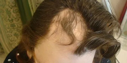 Tratamentul de alopecia areata la femei populară și facilități de farmacie