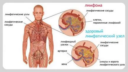 limfóma kezelésére Németországban új módszerek