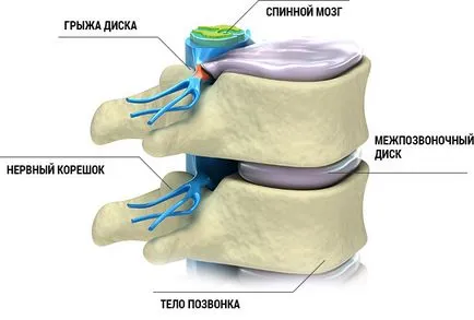 Tratamentul de hernie de disc, fara o interventie chirurgicala - Galium, Medical Wellness Center, Tambov