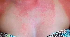 Sugárzás dermatitis fő megnyilvánulásai, hogyan kell kezelni