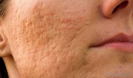 Unguent de cicatrici de acnee remedii pentru acnee cicatrici după