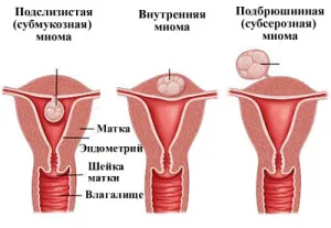 Миома на матката - причини, симптоми и народни средства миома на матката