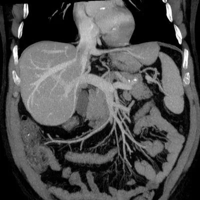 Caracteristici MRI ovarian